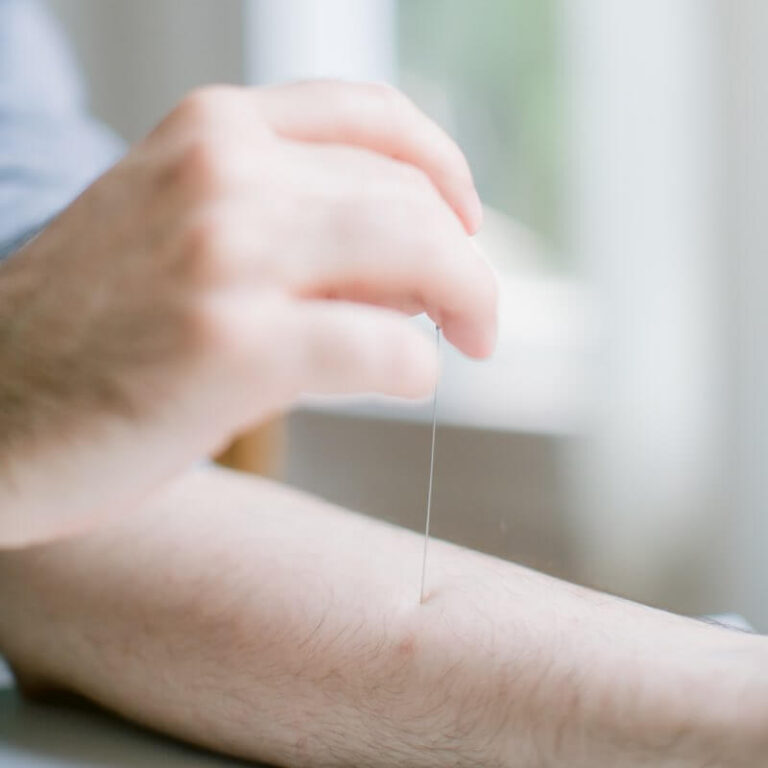 Une aiguielle d'acupuncture sur le bras d'un patient